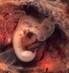 220px-Tubal_Pregnancy_with_embryo.jpg