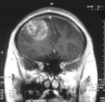 Glioblastoma_.jpg